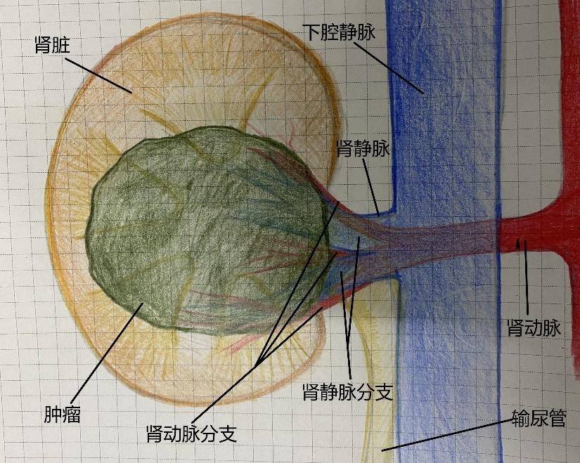 患者術前腎動脈cta來百度app暢享高清圖片57歲的