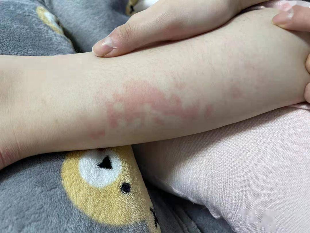 腿上莫名出现了红斑或水泡最近,有人起床后但值得注意的是如热水袋