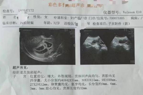 二胎b超显示四个胎囊从他们晒出的b超妊娠单上,可以清晰地看出:宫内