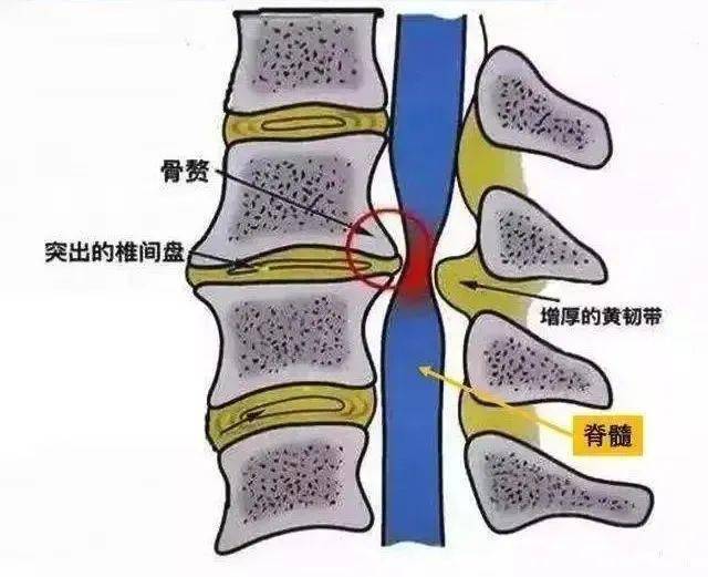 颈椎ct片,如何看?