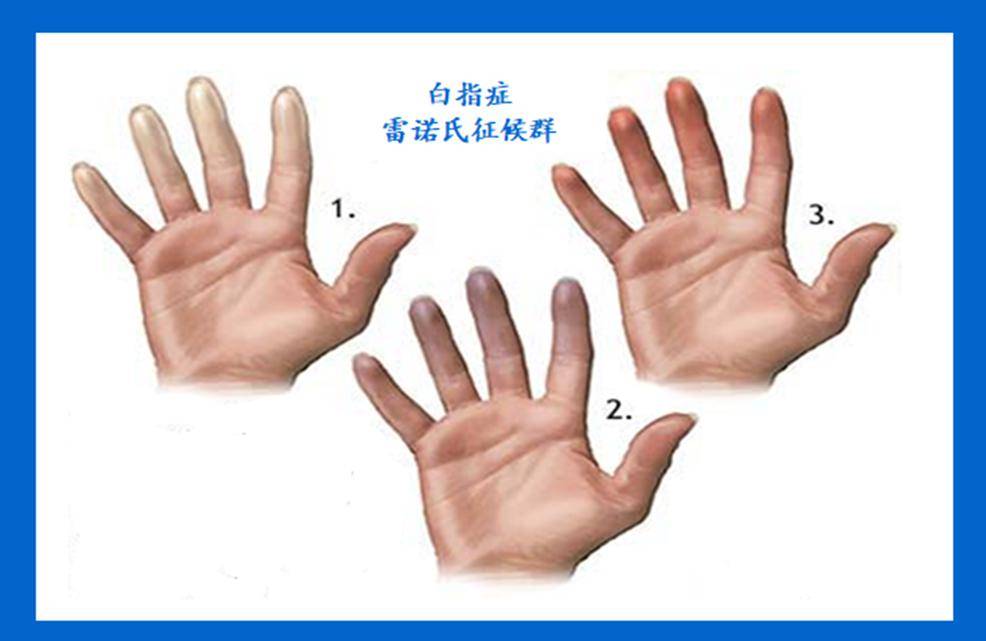 你可能忽视的"冷门"职业病一手臂振动病_作业_诊断_工具