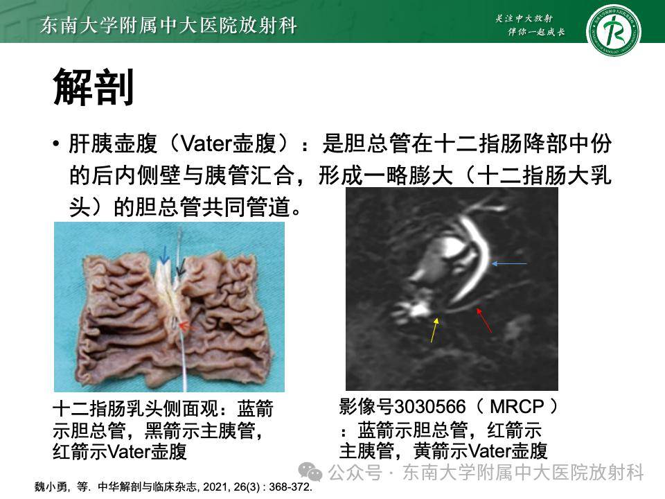 vater壶腹癌影像诊断_全网_解剖图_纳差