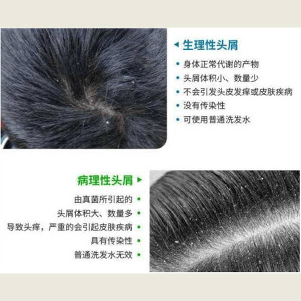 强烈去屑止痒的洗发水_头皮_问题_护理