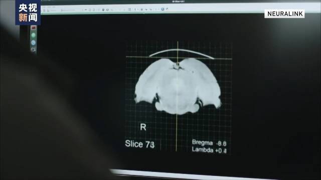 美国企业家马斯克表示首例脑机接口设备人体移植完成-阳光明媚