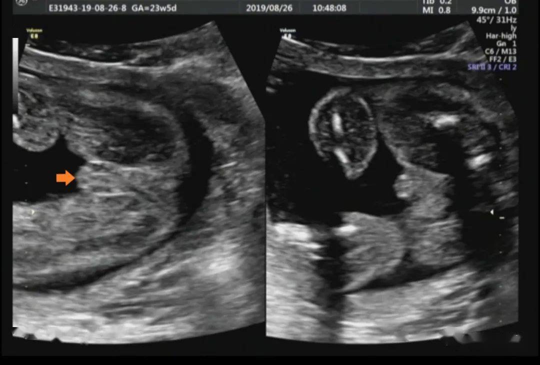 孕12周胎儿小鸡彩超图图片
