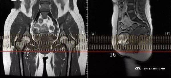 掃盲:( 單,雙 ) 髖關節mri該如何掃描!_序列_調整_定位