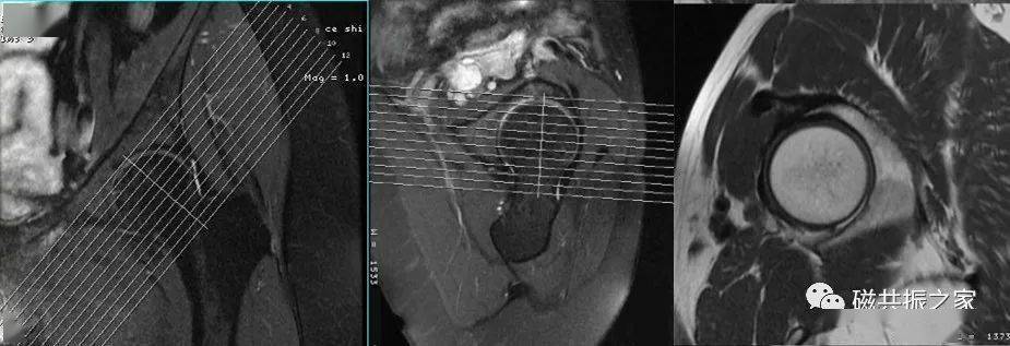 掃盲:( 單,雙 ) 髖關節mri該如何掃描!_序列_調整_定位