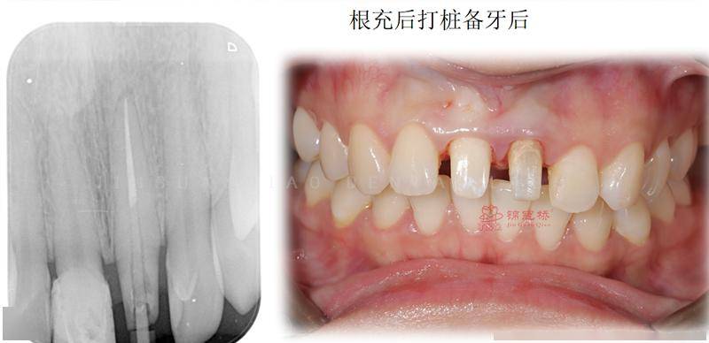 探查齦溝深度: =3mm製作臨時牙修復治療乾燥根管後,氫氧化鈣糊劑消毒