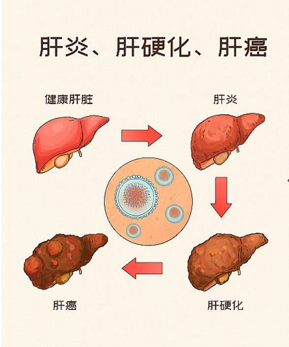 查出肝癌晚期,才知自己有乙肝,别再忽视这个沉默的器官