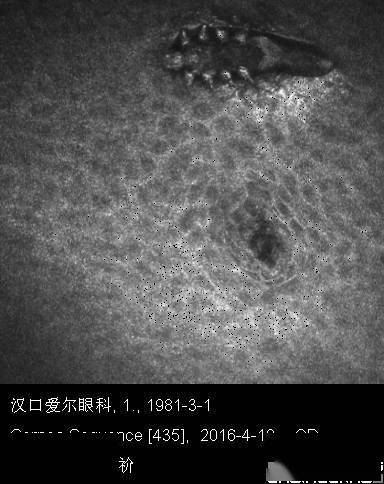 曾庆延教授揭秘蠕形螨睑缘炎的治疗之道:药物除螨与物理治疗并重,重塑