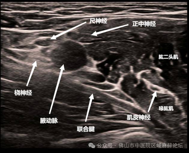 腋路臂丛神经超声图片图片