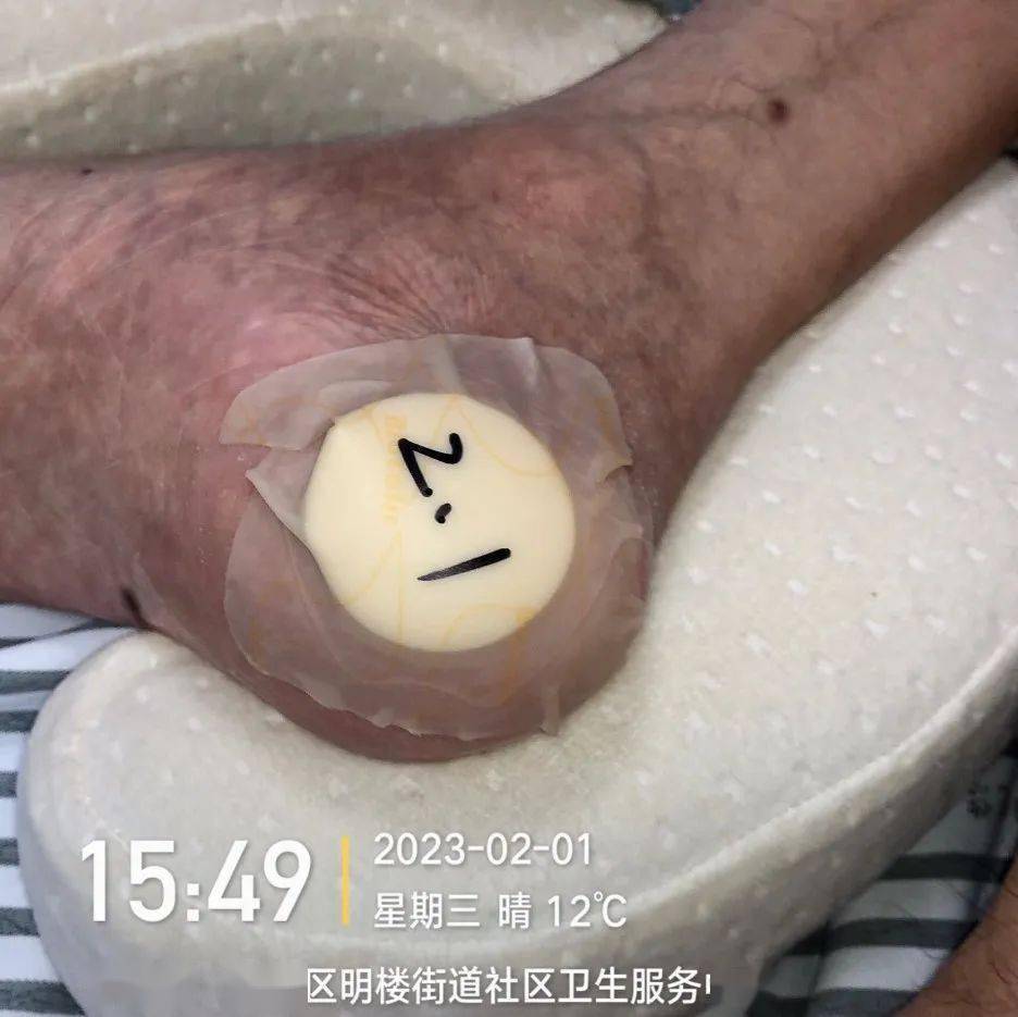 压疮还在用紫药水?看完这篇,压疮换药你就会了