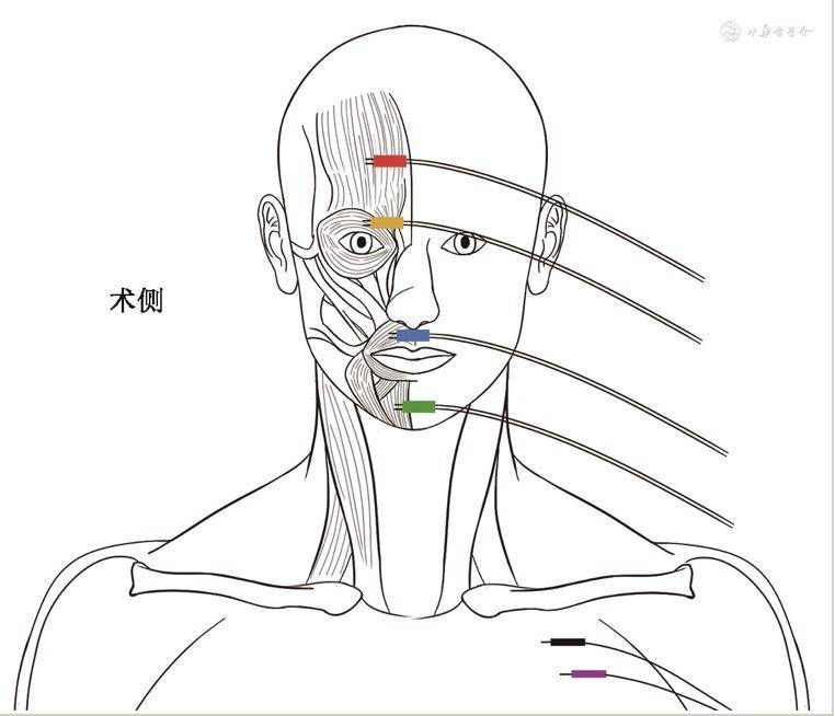 診療方案丨術中面神經監測專家共識_應用_手術_相關