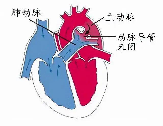 动脉导管未闭解剖位置图片