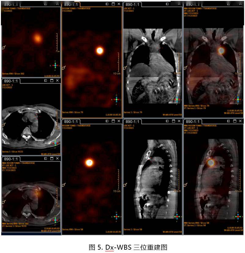 131-碘全身显像成功找到隐匿转移灶_甲状腺_淋巴结_治疗