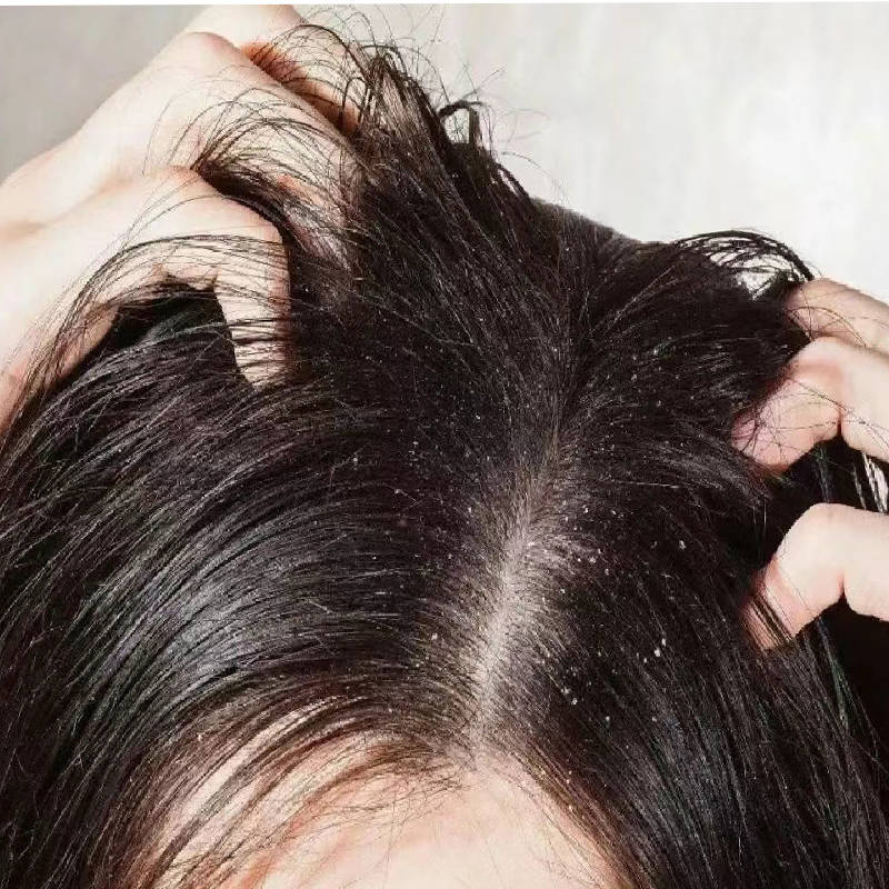 马拉色菌是一种天然存在于头皮上的真菌,当其过度繁殖时,可能导致油脂