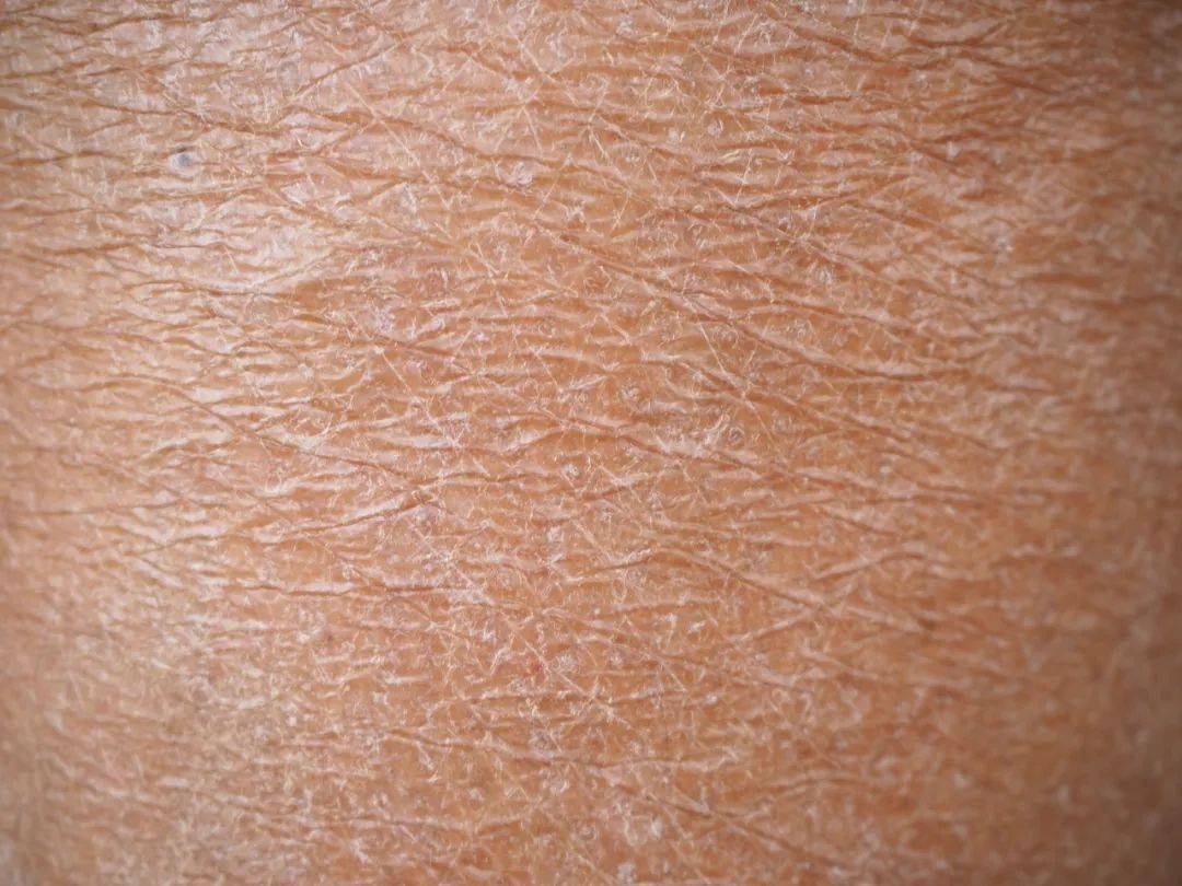 冬季皮肤疾病如何预防?