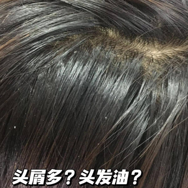 用什么洗头可以去掉头皮屑?国产去头屑洗发水排名