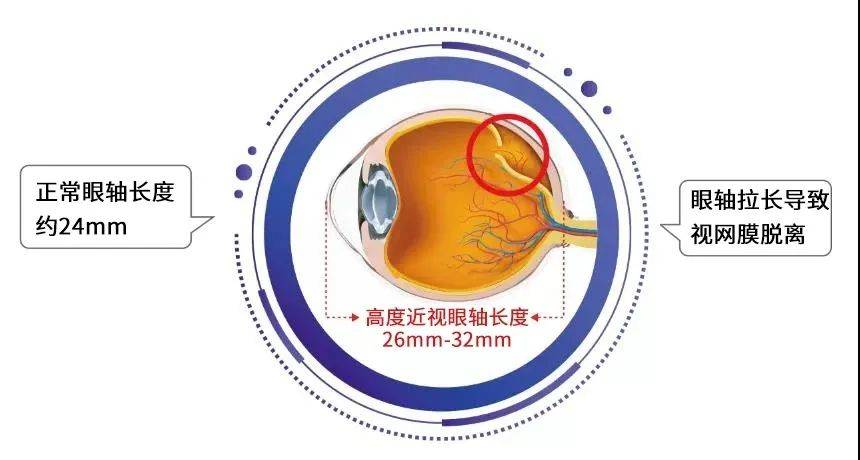 小孩近视玩手机需要戴眼镜吗_小孩玩手机近视眼怎么恢复视力_孩子近视了还能玩手机吗