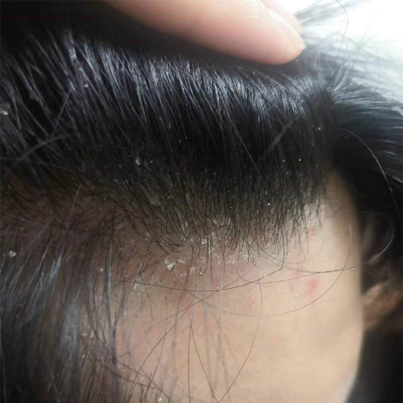 头皮屑多的原因 来自搜狐网