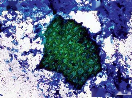9张镜检图片总结粪便检查中的正常发现:酵母菌,植物,黏液,上皮细胞