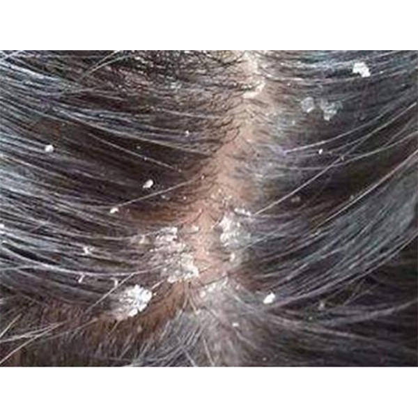 头皮屑红疹等头皮问题产生的原因:大块头屑,头痒,毛囊炎,小红疹,忠珑