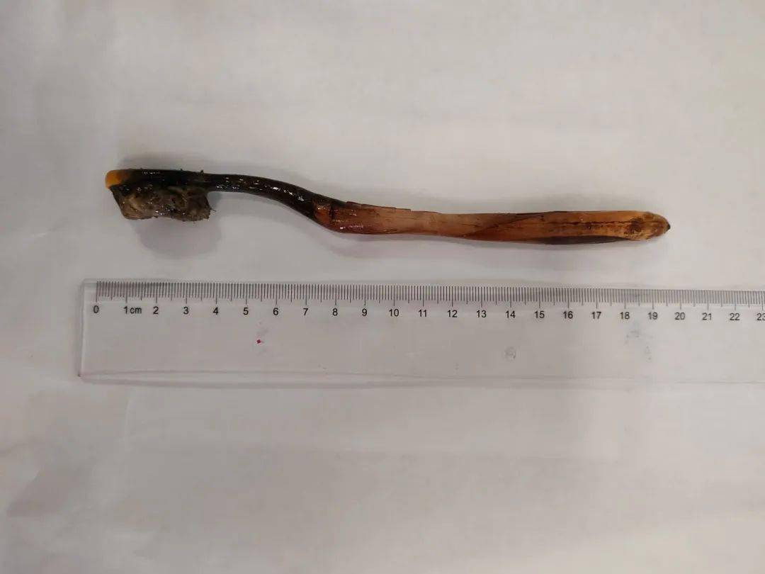 专家提示:如有家人或朋友误吞了异物切勿粗心大意,采取喝醋,喝水