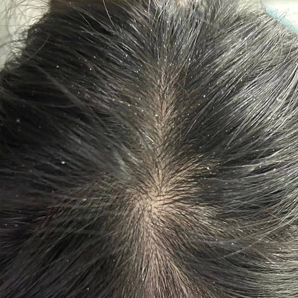 二硫化硒的洗发水有哪些牌子?强力去油去屑的洗发水