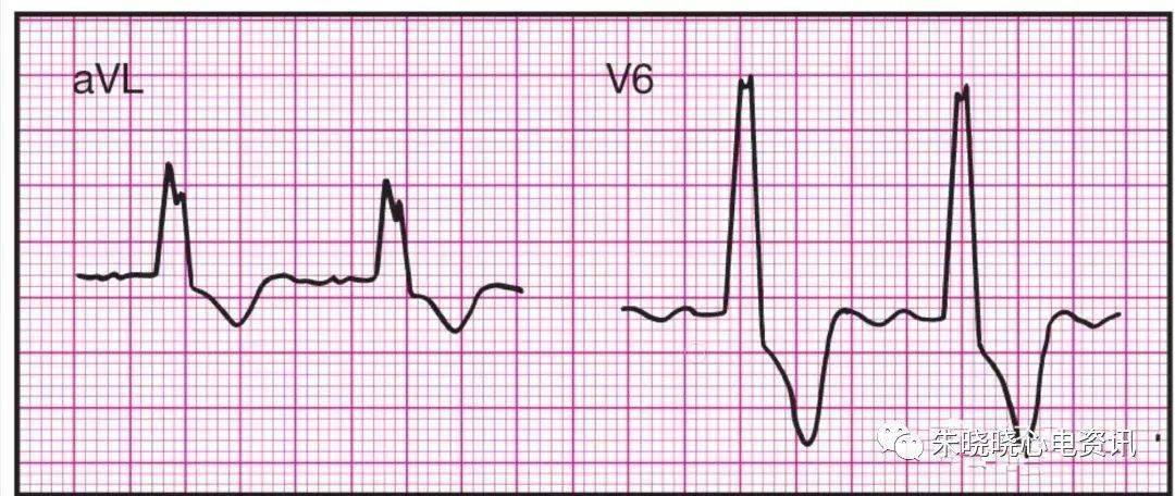 典型异常心电图图谱图片