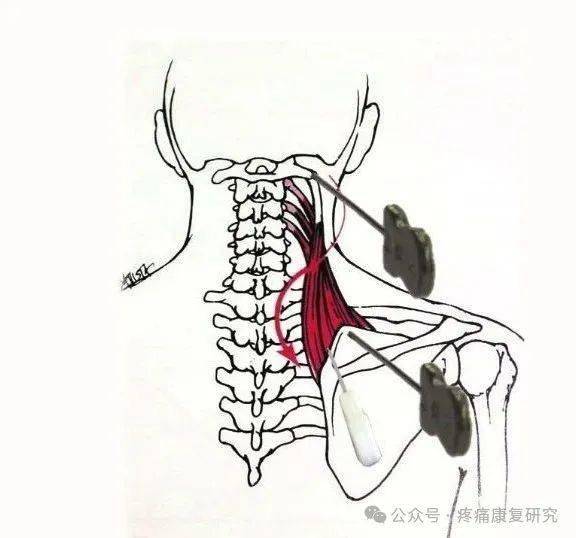 肩胛骨上角顽固性疼痛,最可能与这块肌肉有关_按摩_患者_触发