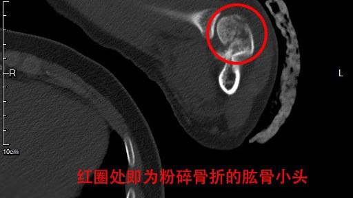 差点无法拿起手术刀:甘肃进修医生千里迢迢重回瑞金_肘关节_小蔡_肱骨