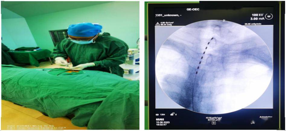 面神经热凝射频治疗面肌痉挛腰交感神经无水酒精阻滞术治疗糖尿病足