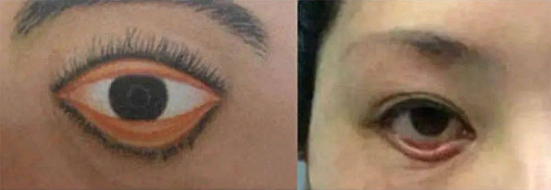 为什么我的眼中常含泪水?_泪道_治疗_泪液