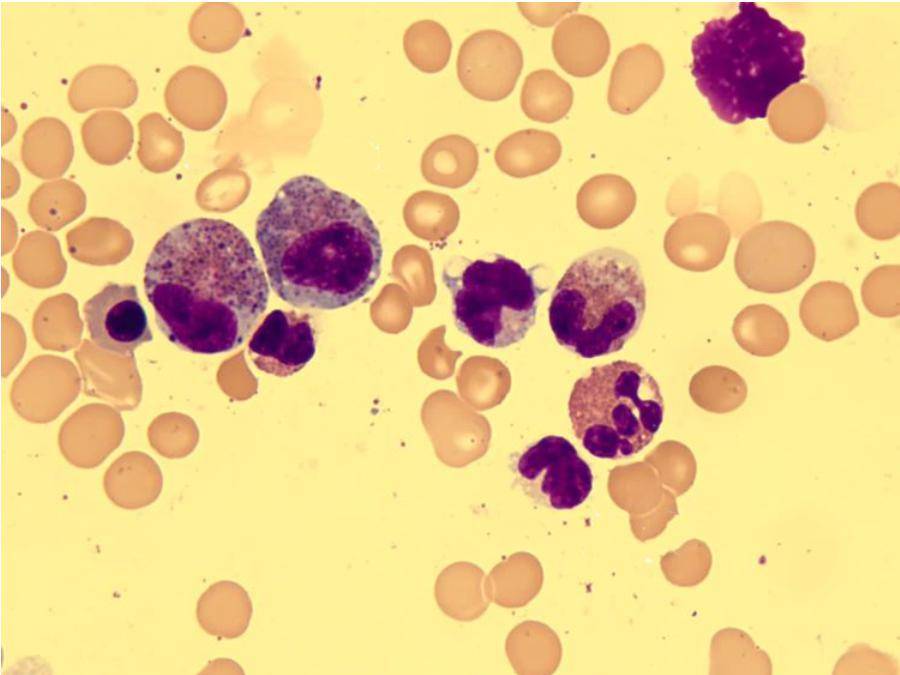 【病例分享】嗜酸性粒细胞胃肠炎_粘膜_组织_食道