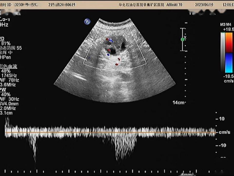 肾癌超声图片