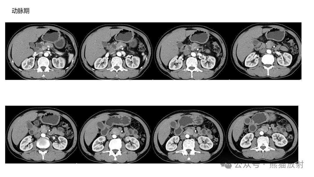 自身免疫性胰腺炎(aip)影像学表现_全网_解剖图_系统