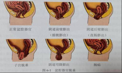 盆腔器官的位置下移,位于阴道内或者阴道外,总感觉下体有异物感,在