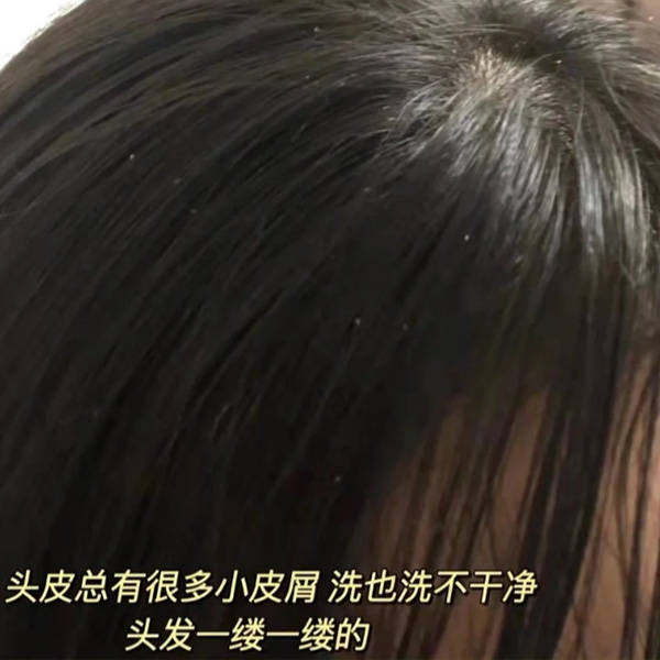 强力去油去屑的洗发水推荐_问题_头皮屑_头发