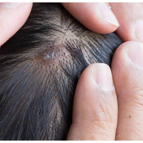 洗发水止痒去屑推荐_清爽_问题_头发