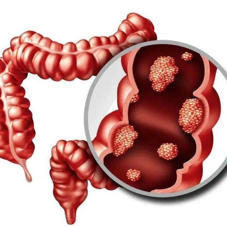 新技术新项目 | 弥勒市中医医院成功开展腹腔镜下直肠癌根治术_患者