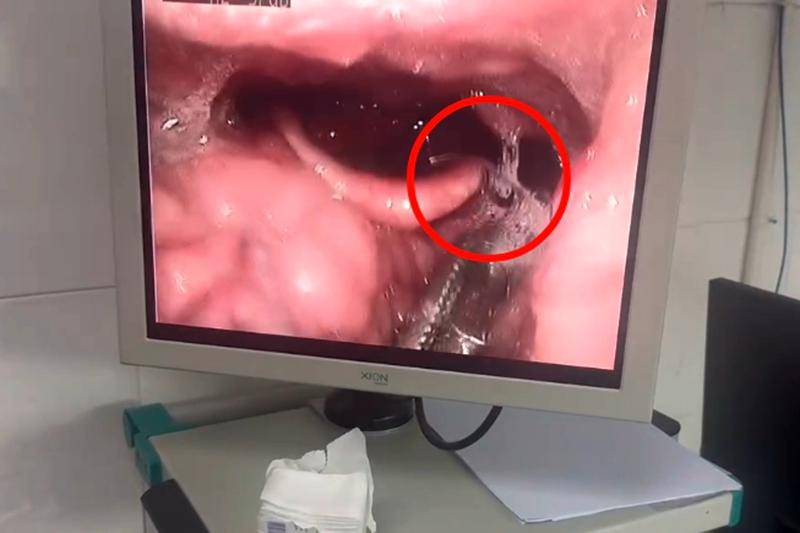 电子喉镜全过程图片