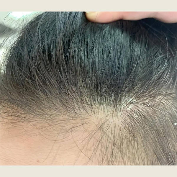 二硫化硒洗发水能止痒吗?洗发水控油蓬松去屑止痒_头皮屑_头发_问题