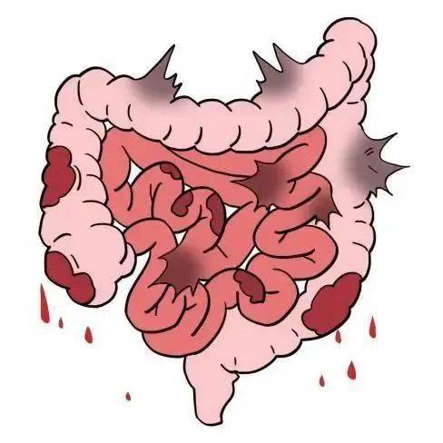 潰瘍性結腸炎的症狀1,腹瀉,黏液膿血便:多反覆發作,主要在疾病活動期