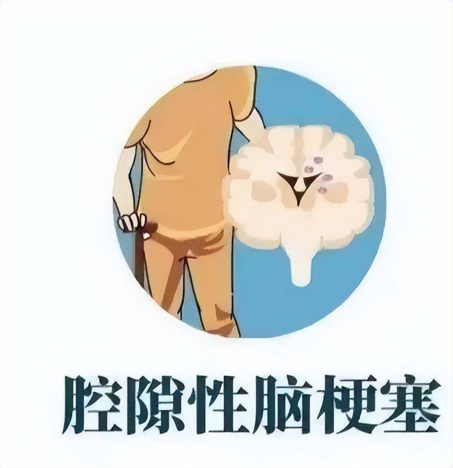 腔隙性脑梗死是哪般?和济医院解答