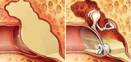 中耳_鼓膜_治疗