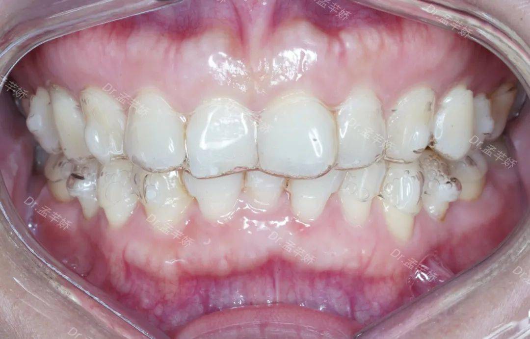 正畸牙套大揭秘!让牙齿矫正不再是难题~_优缺点_安徽_个性化