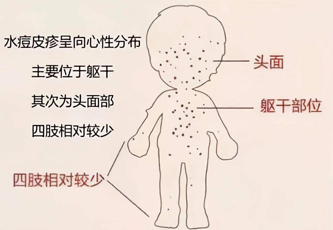 水痘_接种_病毒