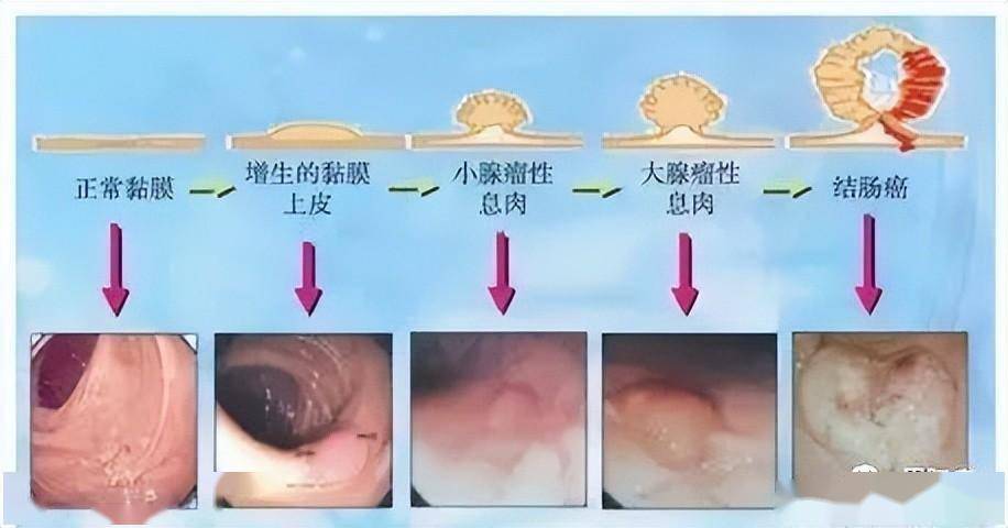 大肠癌好发部位图片