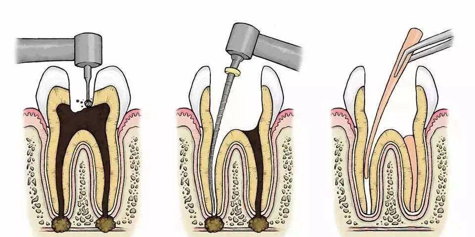 抽牙髓过程图解图片