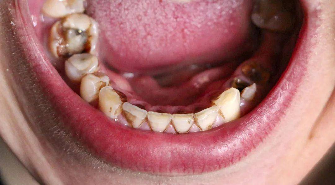 牙龈癌图片 症状图片